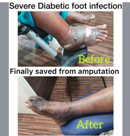 Diabetic foot care Chennai