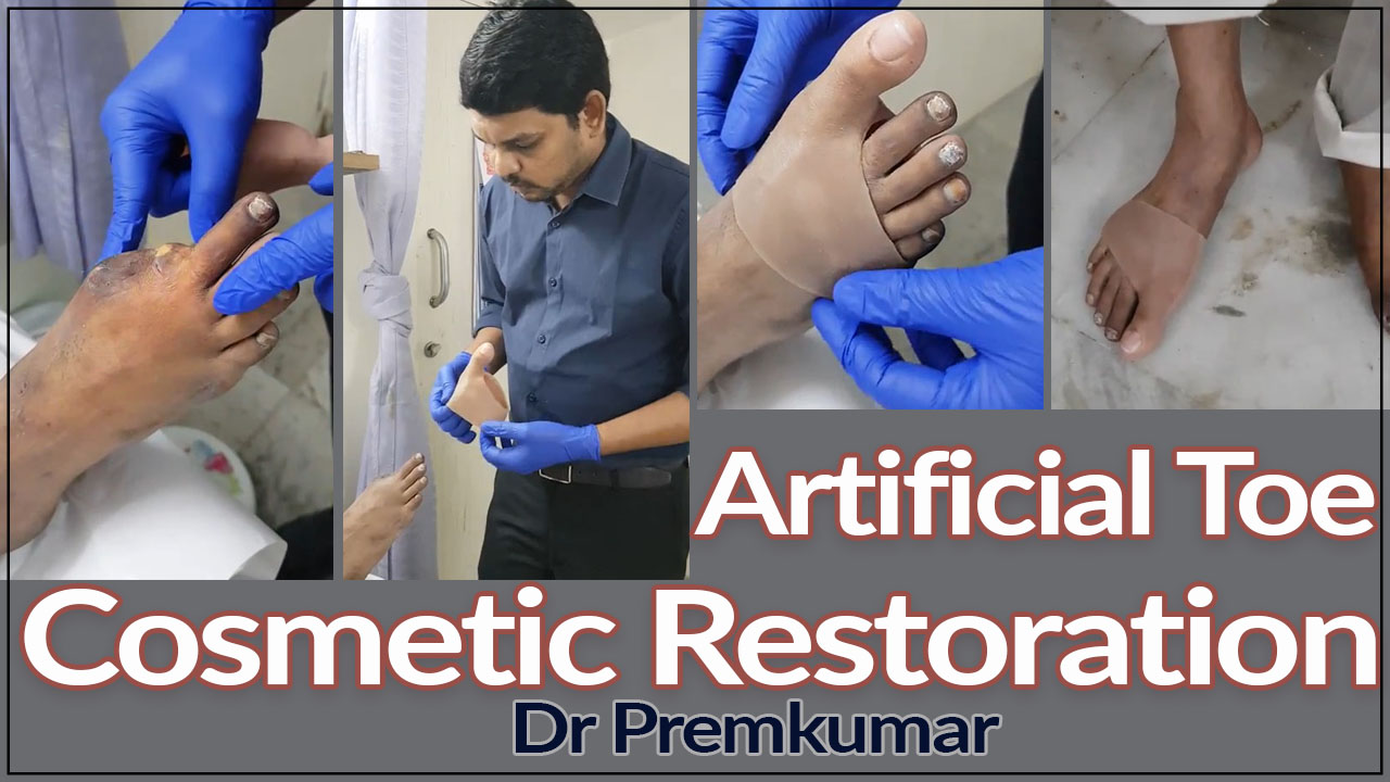 Artificial toe Cosmetic restoration - podiatrist chennai - dr prems diabetic foot - dr premkumar