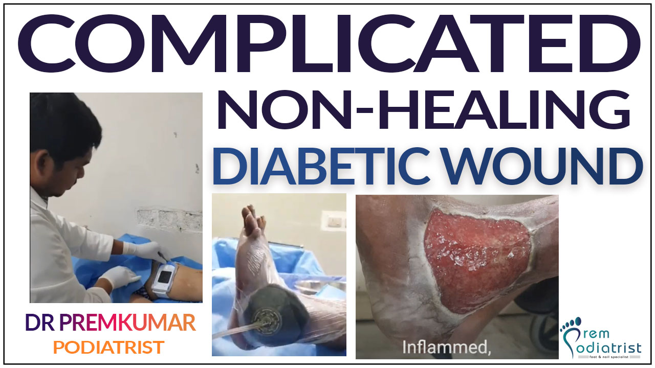 Complicated Non-Healing Diabetic Wound - podiatrist chennai - dr prems diabetic foot