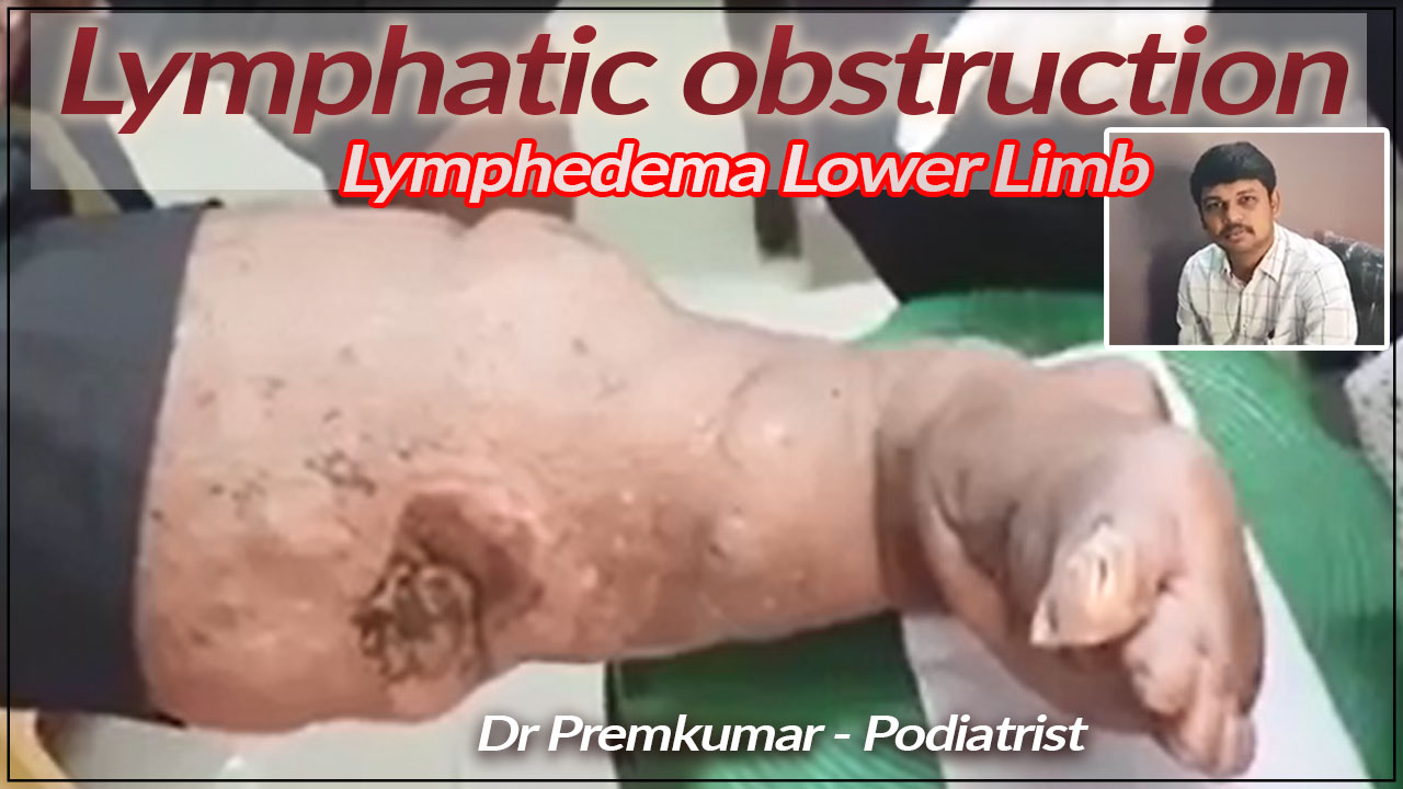 Lymphatic obstruction - podiatrist chennai - dr prems diabetic foot - dr premkumar