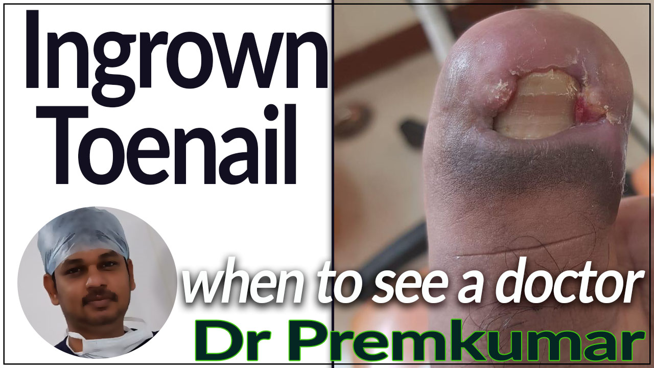 ingrown-toenail - podiatrist chennai - dr prems diabetic foot - dr premkumar
