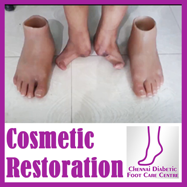 Gallery Ph 9840525242 Chennai Diabetic Foot Care Dr. Premkumar, Podiatrist A Foot