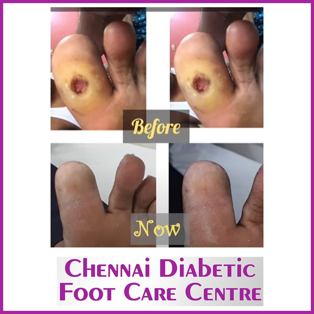 Gallery Ph 9840525242 Chennai Diabetic Foot Care Dr. Premkumar, Podiatrist A Foot