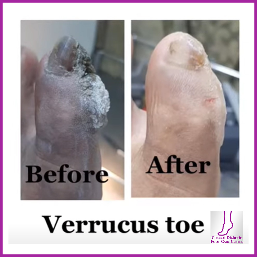 Gallery Ph 9840525242 Chennai Diabetic Foot Care Dr. Premkumar, Podiatrist A Foot