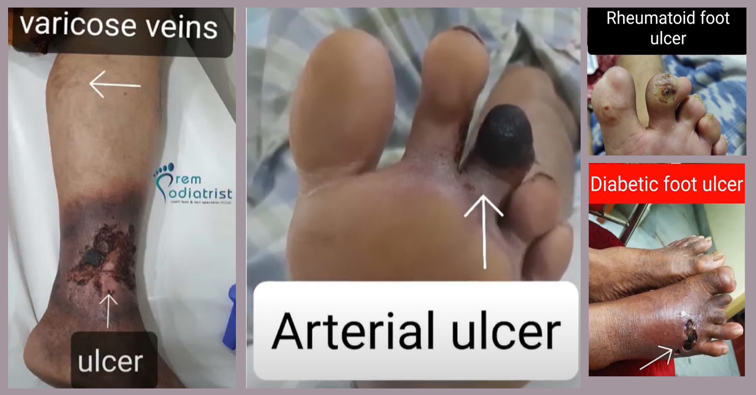 ulcer foot