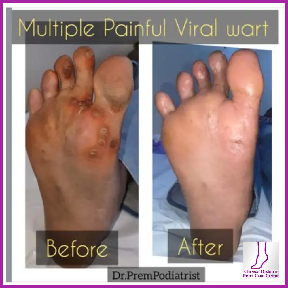 Gallery Ph 9840525242 Chennai Diabetic Foot Care Dr. Premkumar, Podiatrist A Foot