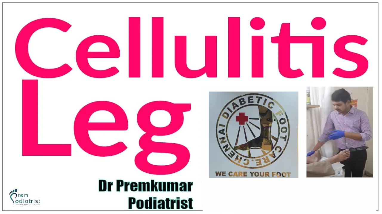 cdfc cellulitis